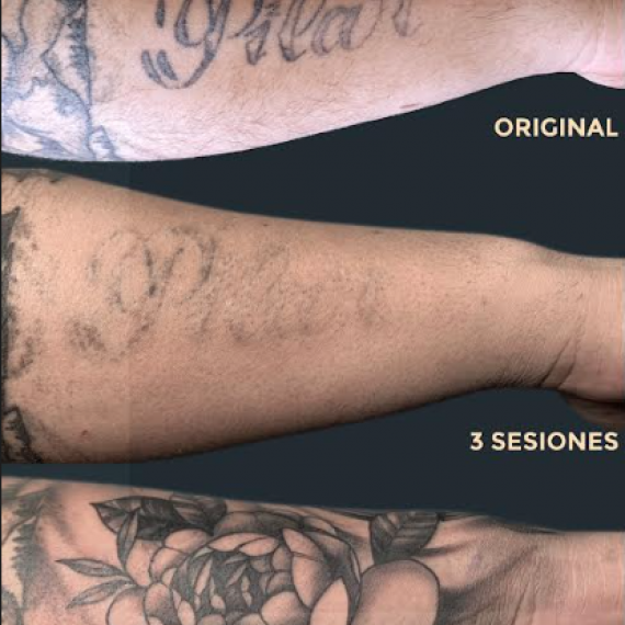 Eliminacion de tatuajes efectiva